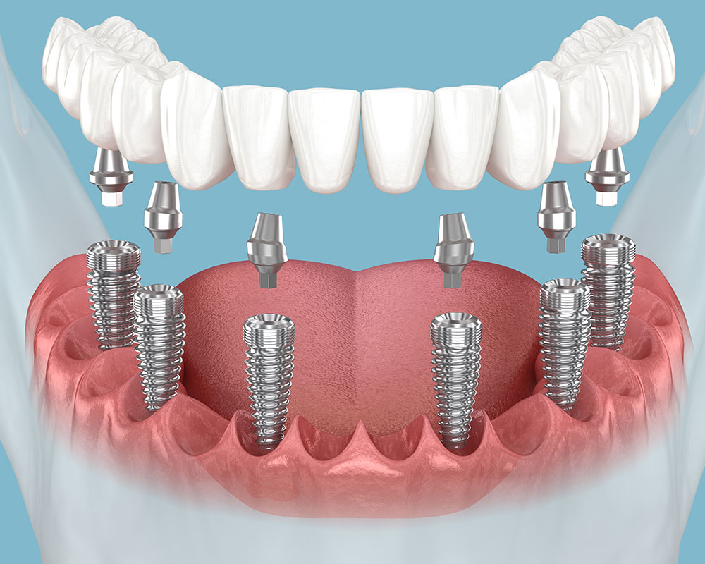 Bridge complet sur implants