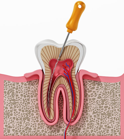Endodontie : le traitement de racine