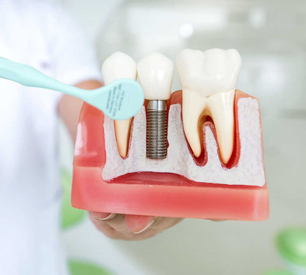 Hygiene-implant-Dentiste-Puteaux-Defense Maintenance implantaire