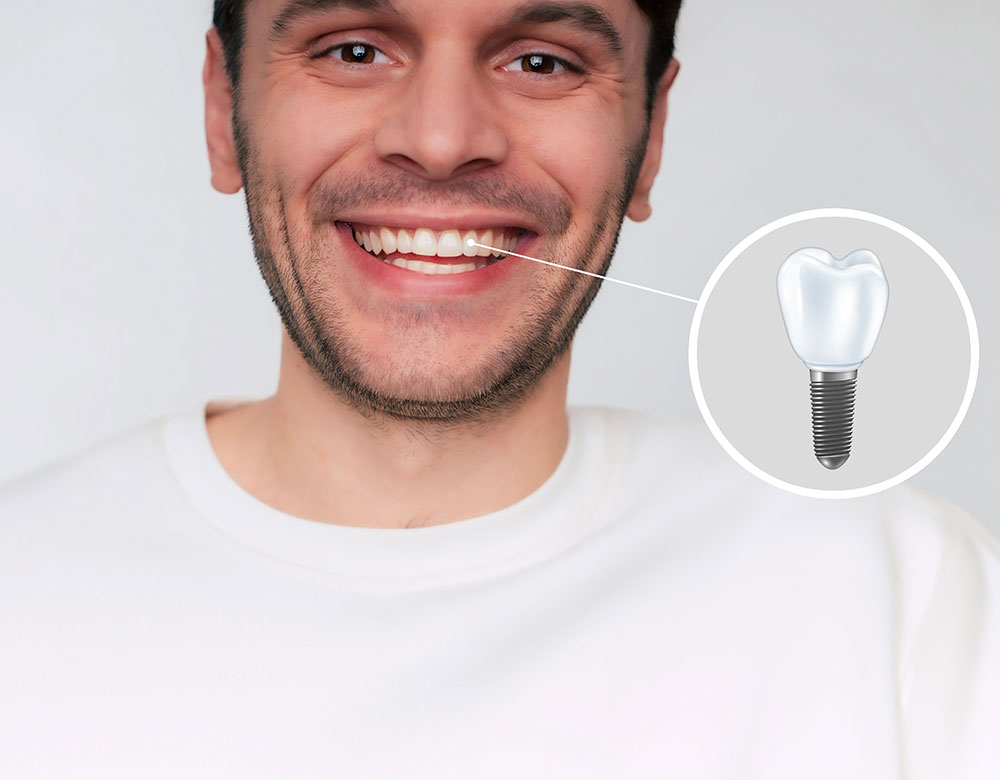 Mise-en-charge-immediate-Dentiste-Puteaux-Defense Mise en charge immédiate