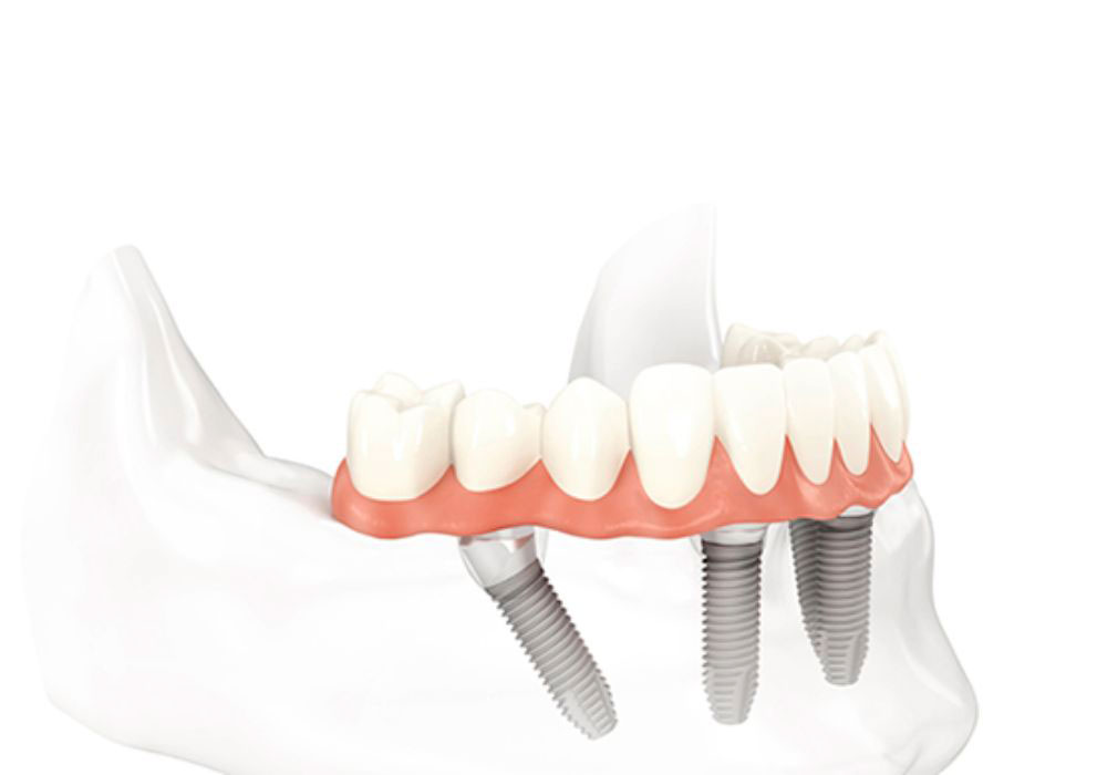 all-on-4-dentiste-Puteaux All-on-4 et All-on-6