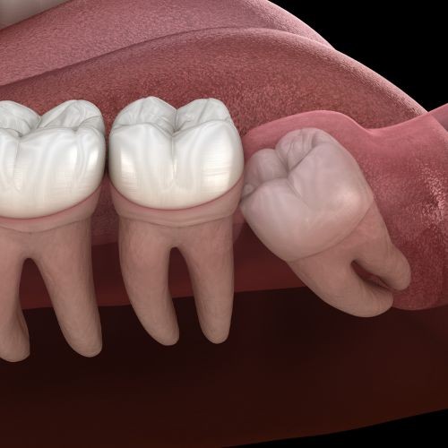 Extraction des dents de sagesse